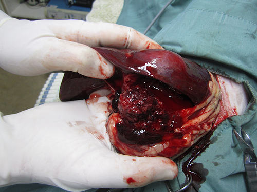 Ruptured splenic tumour