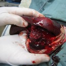 Atypical Bleeding Cases Continued…